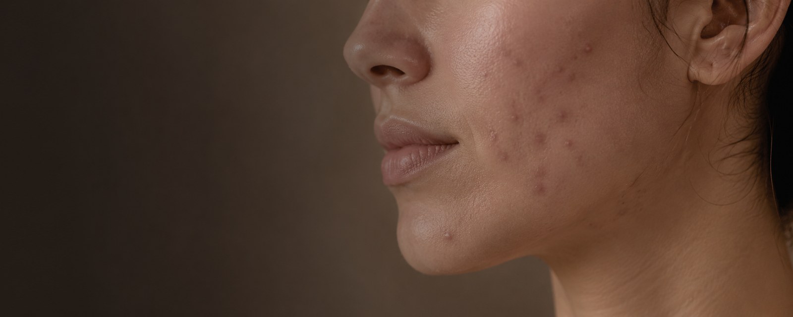 Acne