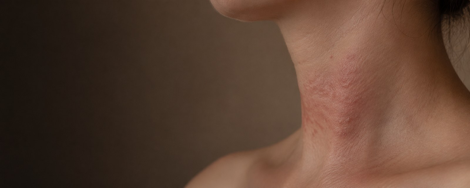 Dermatite de contato
